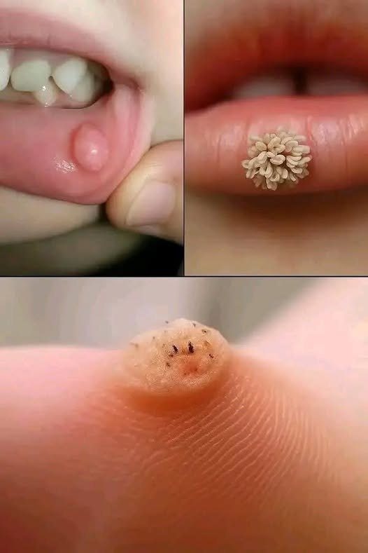 The Power of Patience: Natural Wart Remedies Revealed