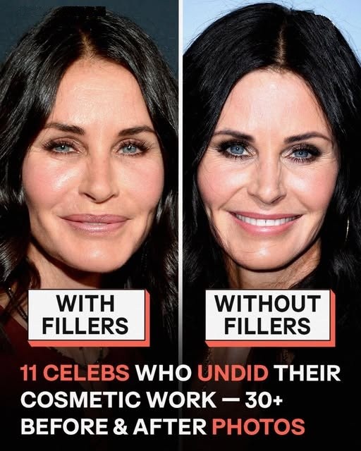 The Faces Behind the Fillers: 11 Celebrities Who Ditched Their Cosmetic Enhancements