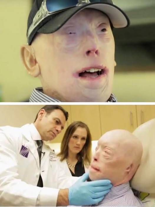 Patrick Hardison Received A New Face After Third-degree Burns, This Is Him Today