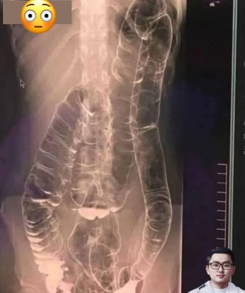 Everything you need to know about chronic constipation, A hidden threat to your digestive health!