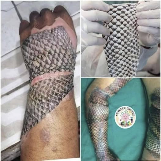 Tilapia Skin: An Innovative Alternative for Burn Recovery