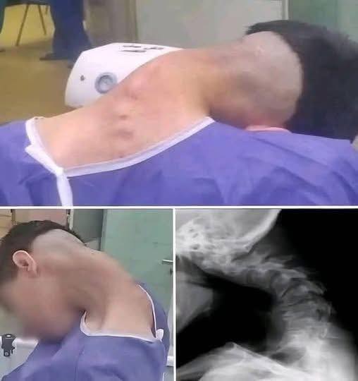 Neck Collapse Alert: The Shocking Case of a Young Man with Dropped Head Syndrome