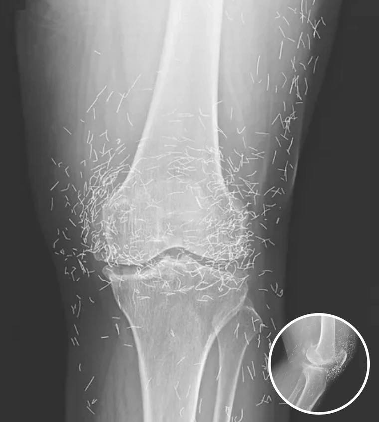 When Healing Turns Hazardous: The Woman with Gold Needles in Her Knees