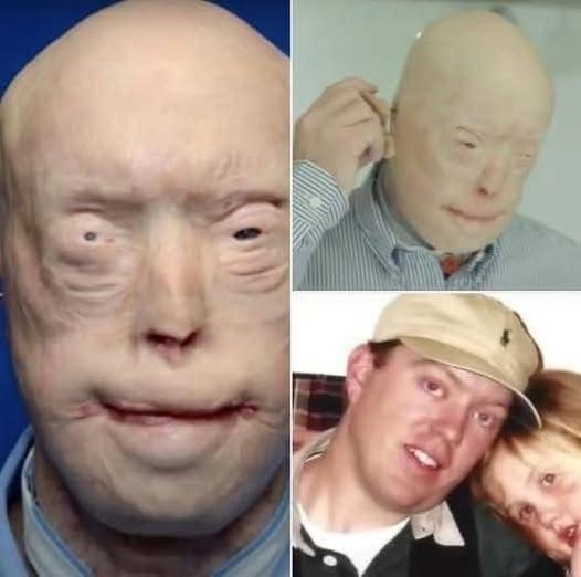 Firefighter suffers third-degree burns – this is him 7 years later!